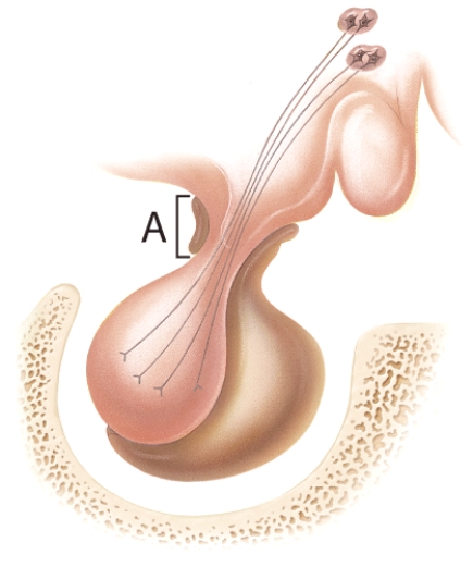 Identify the stalk-like structure labeled A in the diagram.   A) hypothalamus B) anterior pituitary C) posterior pituitary D) infundibulum E) hypophyseal fossa