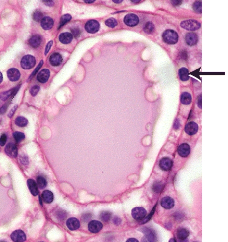 Which of the following hormones is produced by the cells marked in the thyroid follicle shown in the histology picture?   A) calcitonin B) vasopressin C) triiodothyronine (T₃)  D) antidiuretic hormone (ADH)  E) calcitriol