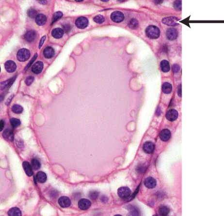 What is the major function of the hormone produced by the cells marked in the thyroid follicle shown in the histology picture?   A) Involved in regulation of calcium homeostasis. B) Enhances contraction of smooth muscle cells in the uterus during delivery. C) In females,initiates development of oocytes.In males,stimulates sperm production. D) Decreases urine volume. E) Increases blood levels of Na⁺ and water.