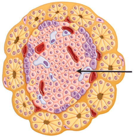 Which of the following diseases result when the cells marked in the histology image are destroyed by the immune system?   A) Cushing's disease B) Addison's disease C) Acromegaly D) Type 1 diabetes E) Diabetes insipidus