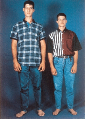 What endocrine abnormality does the individual on the left in the picture of identical twins have?   A) Goiter B) Graves' Disease C) Type 2 diabetes D) Cushing's syndrome E) Gigantism