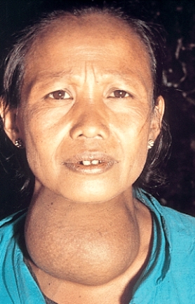 Which of the following endocrine disorders is the individual shown in this picture suffering from?   A) Acromegaly B) Graves' Disease C) Goiter D) Cushing's syndrome E) Giantism