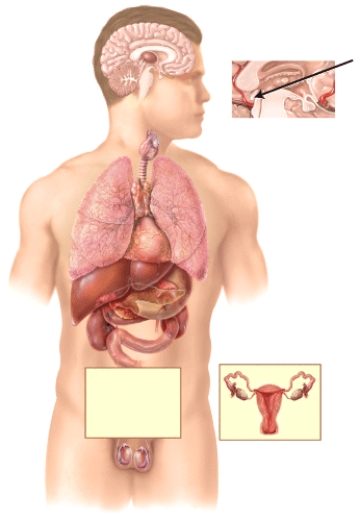 Hypersecretion of a hormone by the endocrine gland marked in the diagram results in a type of depression that affects some people during the winter months,when the day length is short,known as   A) thyroid crisis (storm) . B) general adaptation syndrome (GAS) . C) seasonal affective disorder (SAD) . D) Addisonian crisis. E) posttraumatic stress disorder (PTSD) .
