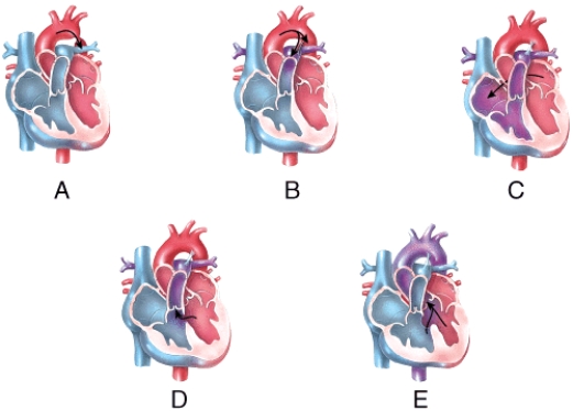 Which of the labeled diagrams shows coarctation of the aorta?   A) A B) B C) C D) D E) E
