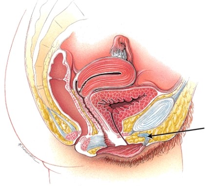 What structure is indicated in the diagram?   A)  ovary B)  uterus C)  vagina D)  clitoris