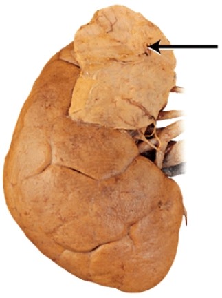 What is the endocrine gland labeled with the arrow?   A)  adrenal B)  pineal C)  thymus D)  testis