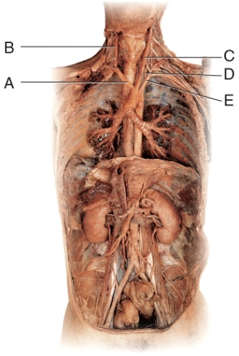 Which of these following vessels of the neck contributes directly to the formation of the basilar artery?   A)  A B)  B C)  C D)  D