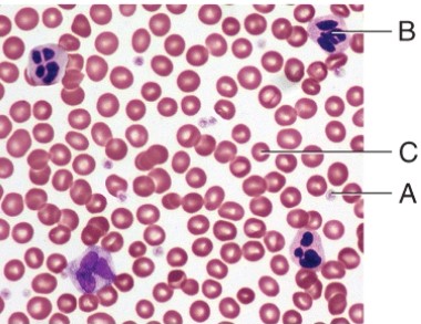 Which cell type is involved in the condition known as Leukemia?   A)  A B)  B C)  C D)  None of these choices