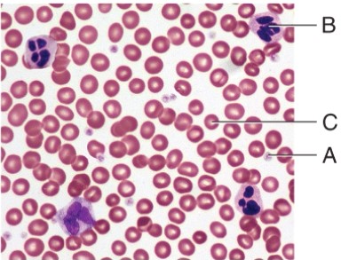 Which cell type is involved in the condition known as Thrombocytopenia?   A)  A B)  B C)  C D)  None of these choices