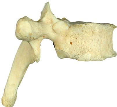 <strong>What type of vertebra is shown in here?  </strong> A) cervical B) thoracic C) lumbar D) sacral <div style=padding-top: 35px> 