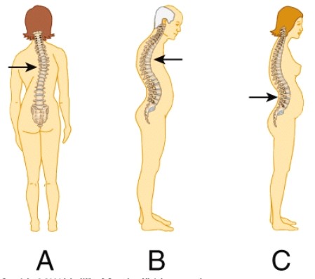 <strong>Which of the following exhibits an abnormal kyphotic curvature of the spine?  </strong> A) A B) B C) C <div style=padding-top: 35px> 