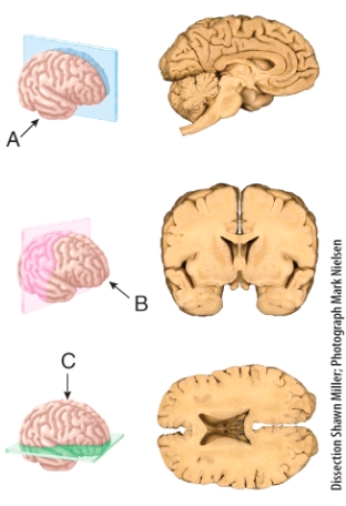 The section shown in (b) results from cutting through a _______ plane extending through the brain?   A) frontal B) sagittal C) oblique D) midsagittal E) transverse