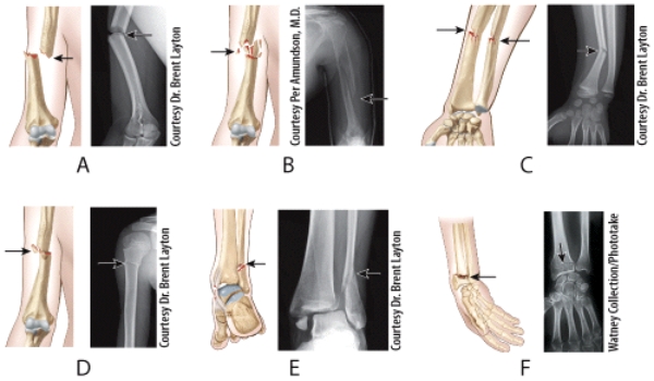 Which illustration and radiograph in the figure shows a Pott's fracture?   A) A B) B C) C D) D E) E
