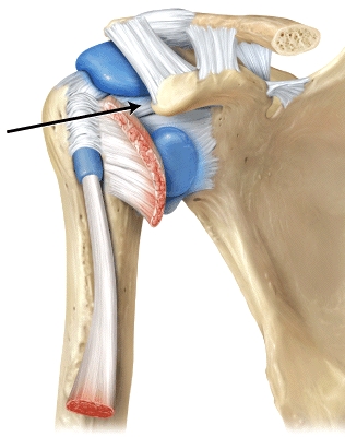 The line is pointing to the _____ ligaments.   A) coracoacromial B) acromioclavicular C) glenohumeral D) coracohumeral