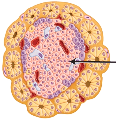 Which of the following diseases result when the cells marked in the histology image are destroyed by the immune system?   A) Cushing's disease B) Addison's disease C) Acromegaly D) Type 1 diabetes E) Diabetes insipidus