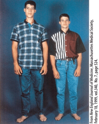 What endocrine abnormality does the individual on the left in the picture of identical twins have?   A) Goiter B) Graves' Disease C) Type 2 diabetes D) Cushing's syndrome E) Gigantism