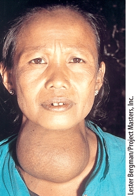 Which of the following endocrine disorders is the individual shown in this picture suffering from?   A) Acromegaly B) Graves' Disease C) Goiter D) Cushing's syndrome E) Giantism