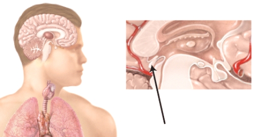 Seasonal affective disorder is due to hypersecretion of which following hormones by the endocrine gland marked in the diagram?   A) testosterone B) glucagon C) melatonin D) aldosterone E) vasopressin