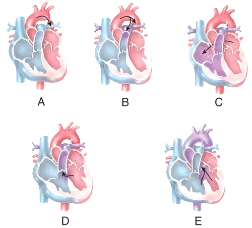 Which of the labeled diagrams shows coarctation of the aorta?   A) A B) B C) C D) D E) E