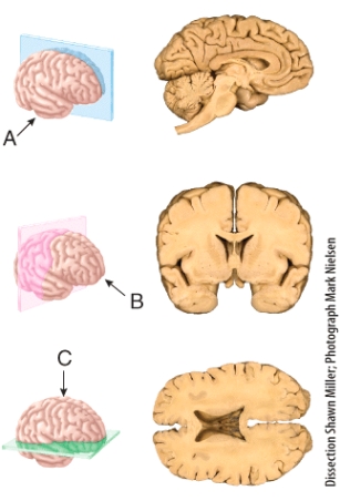 The section shown in (C) results from cutting through a _____ plane extending through the brain?   A) frontal B) sagittal C) oblique D) midsagittal E) transverse