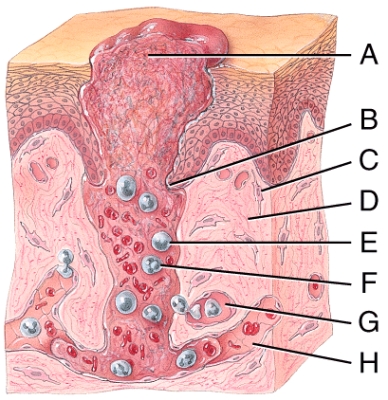 Which of the labeled cells in the diagram of deep wound healing shown below create the framework of fibers that new tissue is built?   A) B B) C C) E D) F