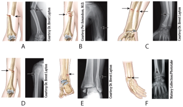 Which illustration and radiograph in the figure shows a Pott's fracture?   A) A B) B C) C D) D E) E