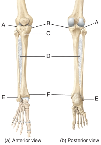 In the diagram of the tibia and fibula,which structure(s) articulate(s) with the talus and forms a protrusion on the medial surface of the ankle?   A) A B) E C) F D) Both E and F E) Not labeled on the diagram.