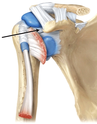 The function of the ligament the line is pointing to is     a)strengthens superior part of the articular capsule b)joint stabilization when present c)secures the long head of the biceps brachii d)helps enlarge the glenoid cavity