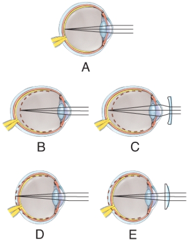An uncorrected hyperopic eye is seen in which diagram?   A) A B) B C) C D) D E) E