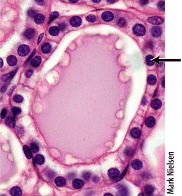 Which of the following hormones is produced by the cells marked in the thyroid follicle shown in the histology picture?   A) calcitonin B) vasopressin C) triiodothyronine (T<sub>3</sub>)  D) antidiuretic hormone (ADH)  E) calcitriol