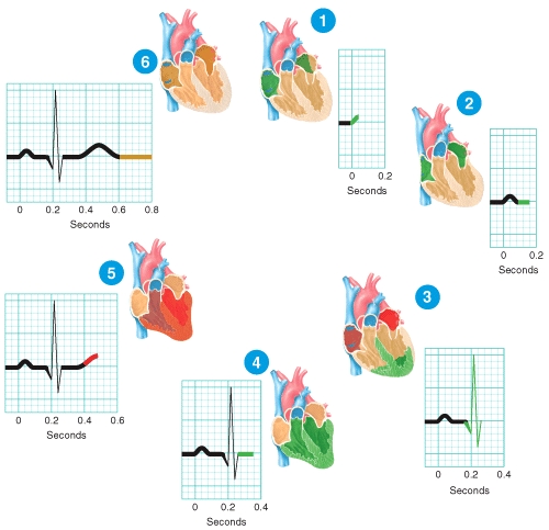 Briefly describe what is happening at the stage of the ECG labeled 5 in the diagram.   
