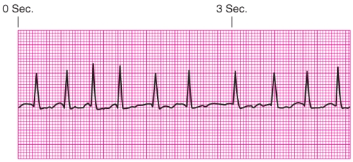 Identify the rhythm.   A)  Junctional escape rhythm B)  Atrial fibrillation C)  Unifocal premature ventricular contractions D)  Ventricular tachycardia