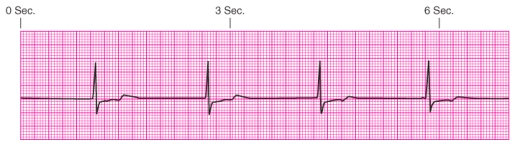 Identify the rhythm.   A)  Junctional escape rhythm B)  Atrial fibrillation C)  Unifocal premature ventricular contractions D)  Ventricular tachycardia