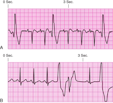 Identify the rhythm.   A)  Junctional escape rhythm B)  Atrial fibrillation C)  Unifocal premature ventricular contractions D)  Ventricular tachycardia