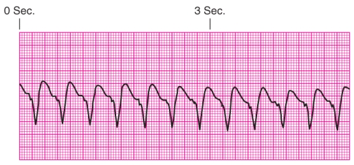 Identify the rhythm.   A)  Junctional escape rhythm B)  Atrial fibrillation C)  Unifocal premature ventricular contractions D)  Ventricular tachycardia