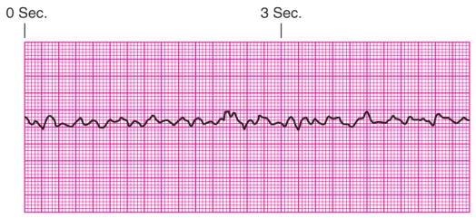 Identify the rhythm.   A)  Ventricular tachycardia B)  Ventricular fibrillation C)  Supraventricular tachycardia D)  Torsades de pointes