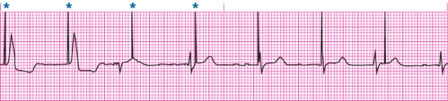 Identify complications with the above rhythm strip.   A)  Undersensing from a pacemaker B)  Oversensing from a pacemaker C)  ICD firing caused by VF D)  Atrial pacing failure to capture
