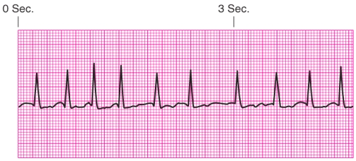 Identify the rhythm.   A)  Junctional escape rhythm B)  Atrial fibrillation C)  Unifocal premature ventricular contractions D)  Ventricular tachycardia