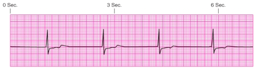 Identify the rhythm.   A)  Junctional escape rhythm B)  Atrial fibrillation C)  Unifocal premature ventricular contractions D)  Ventricular tachycardia