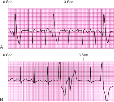 Identify the rhythm.   A)  Junctional escape rhythm B)  Atrial fibrillation C)  Unifocal premature ventricular contractions D)  Ventricular tachycardia