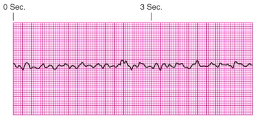 Identify the rhythm.   A)  Ventricular tachycardia B)  Ventricular fibrillation C)  Supraventricular tachycardia D)  Torsades de pointes