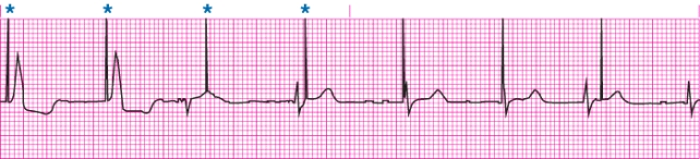 Identify complications with the above rhythm strip.   A)  Undersensing from a pacemaker B)  Oversensing from a pacemaker C)  ICD firing caused by VF D)  Atrial pacing failure to capture
