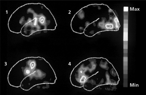   Which of the PET images above shows high levels of activity in the occipital lobe? A)  1 B)  2 C)  3 D)  4
