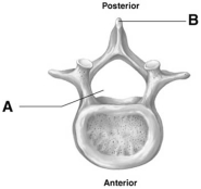   -  This figure illustrates A)  the atlas. B)  the axis. C)  a general cervical vertebrae (C3-C7) . D)  a general thoracic vertebrae. E)  a general lumbar vertebrae.