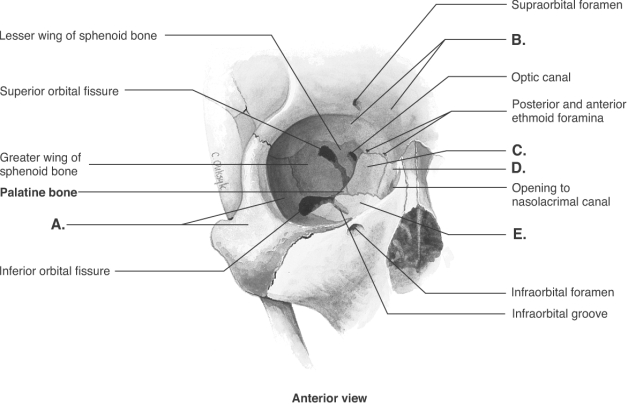   -The figure shows the bones of the right orbit. What bone does  B  represent? A)  frontal B)  maxilla C)  zygomatic D)  lacrimal E)  ethmoid