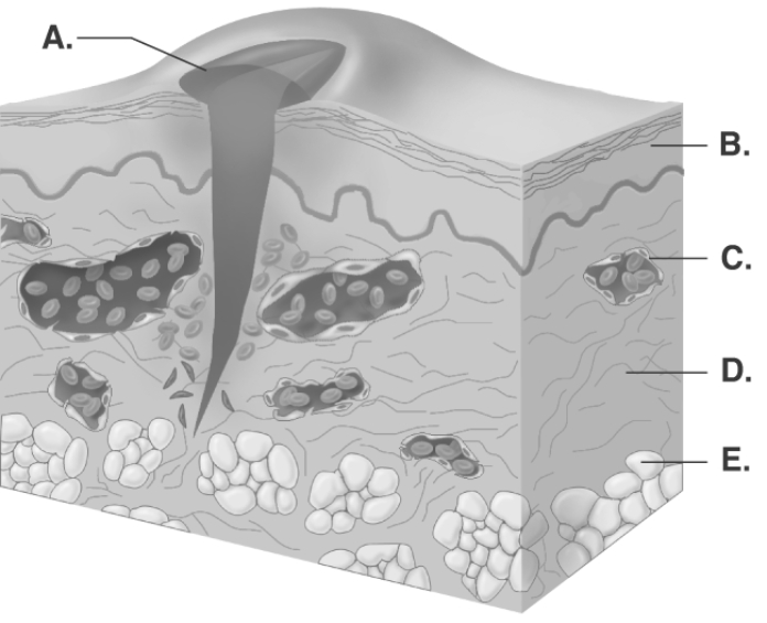   -This is a picture of a skin wound. What does  A  represent? A)  dermis B)  subcutaneous fat C)  epidermis D)  blood vessel E)  blood clot