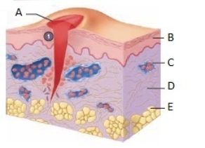   -What is a malignant neoplasm derived from connective tissue? A) metastasis B) malignant C) sarcoma D) benign E) carcinoma