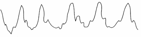 On the basis of the following waveform,in which of the following anatomic locations is the distal tip of the pulmonary artery catheter located?   A) Right atrium B) Right ventricle C) Pulmonary artery D) Wedged position
