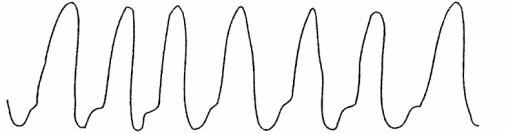 On the basis of the following waveform,in which of the following anatomic locations is the distal tip of the pulmonary artery catheter located?   A) Right atrium B) Right ventricle C) Pulmonary artery D) Wedged position