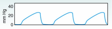 The following capnogram was obtained from a newborn infant receiving mechanical ventilation.   How should the therapist evaluate this capnogram? A) Airway obstruction B) Hypoventilation C) Hyperventilation D) Increased dead space ventilation